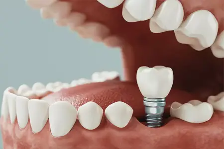 imagem implante odontologia